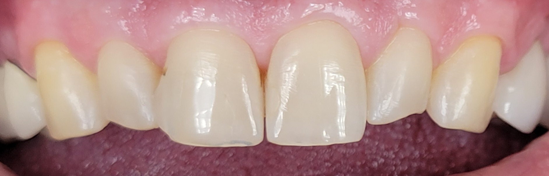 before treatment by Dr. Saccheti at Future of Dentistry