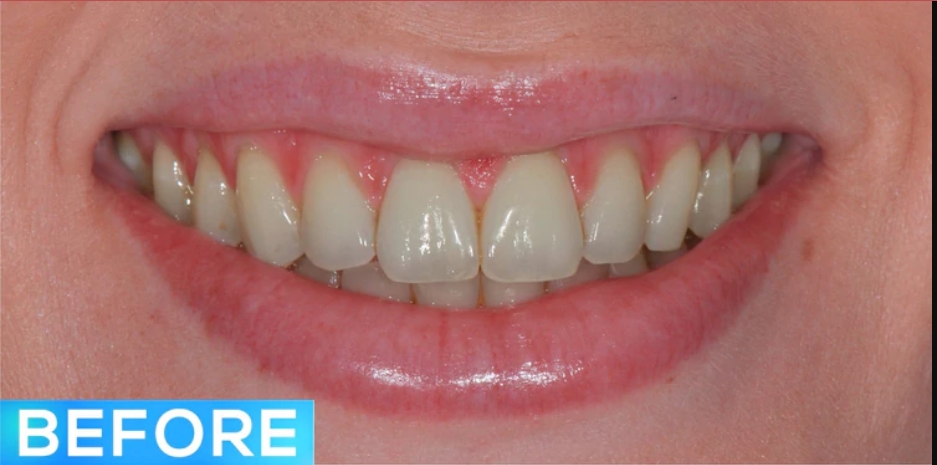 before teeth whitening by cosmetic dentists at Future of Dentistry