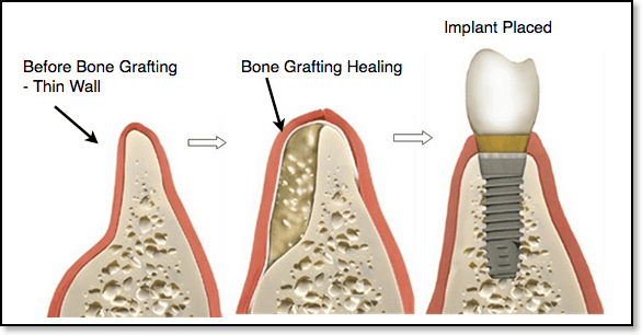 bone graft at Future of Dentistry serving Wakefield, North Andover, Chelmsford, Dracut, and Billerica
