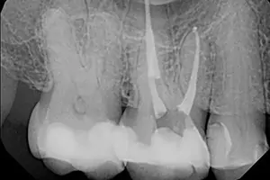 x-ray of a root canal at Future of Dentistry serving North Andover, Wakefield, Chelmsford, and more