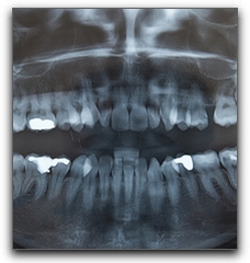 wisdom teeth extraction in Billerica, Chelmsford, and North Andover