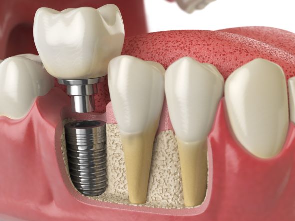 Dental implants in Billerica MA