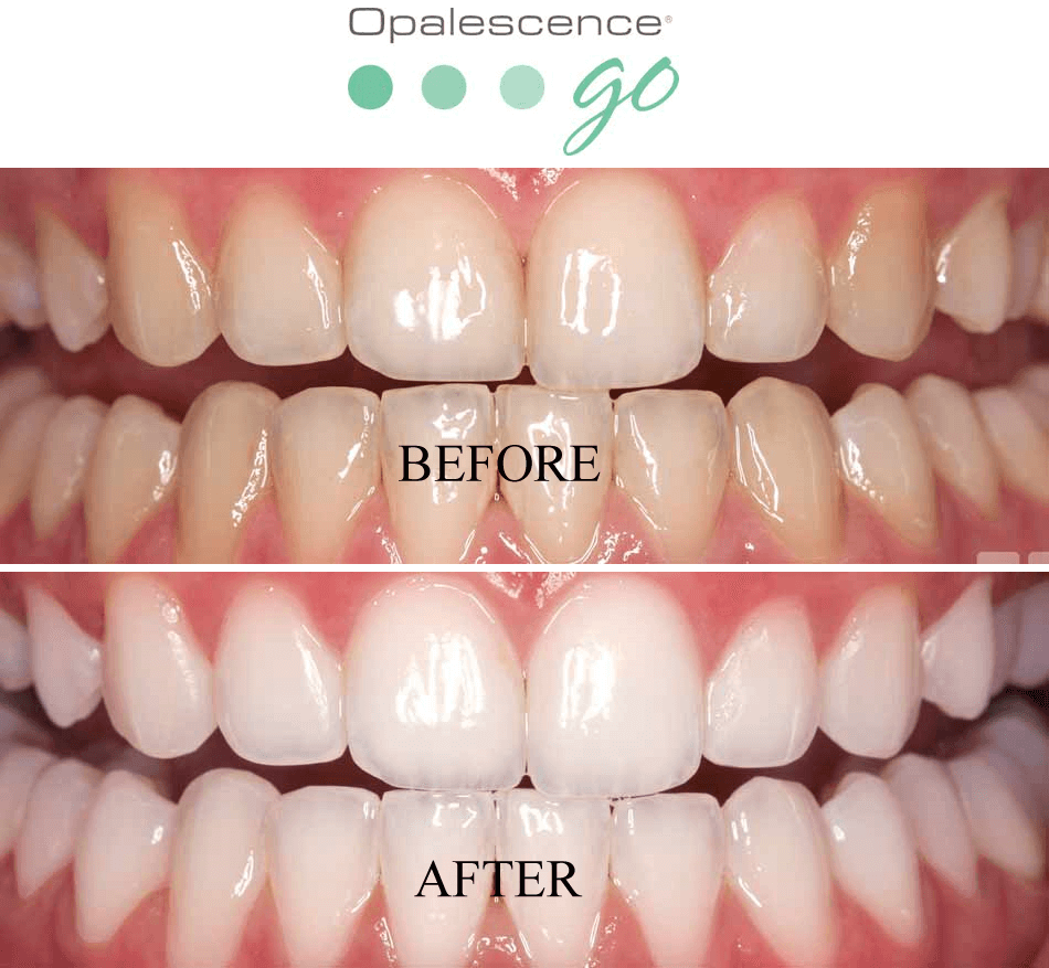 Opalescence Go teeth whitening from Future of Dentistry in Billerica, MA