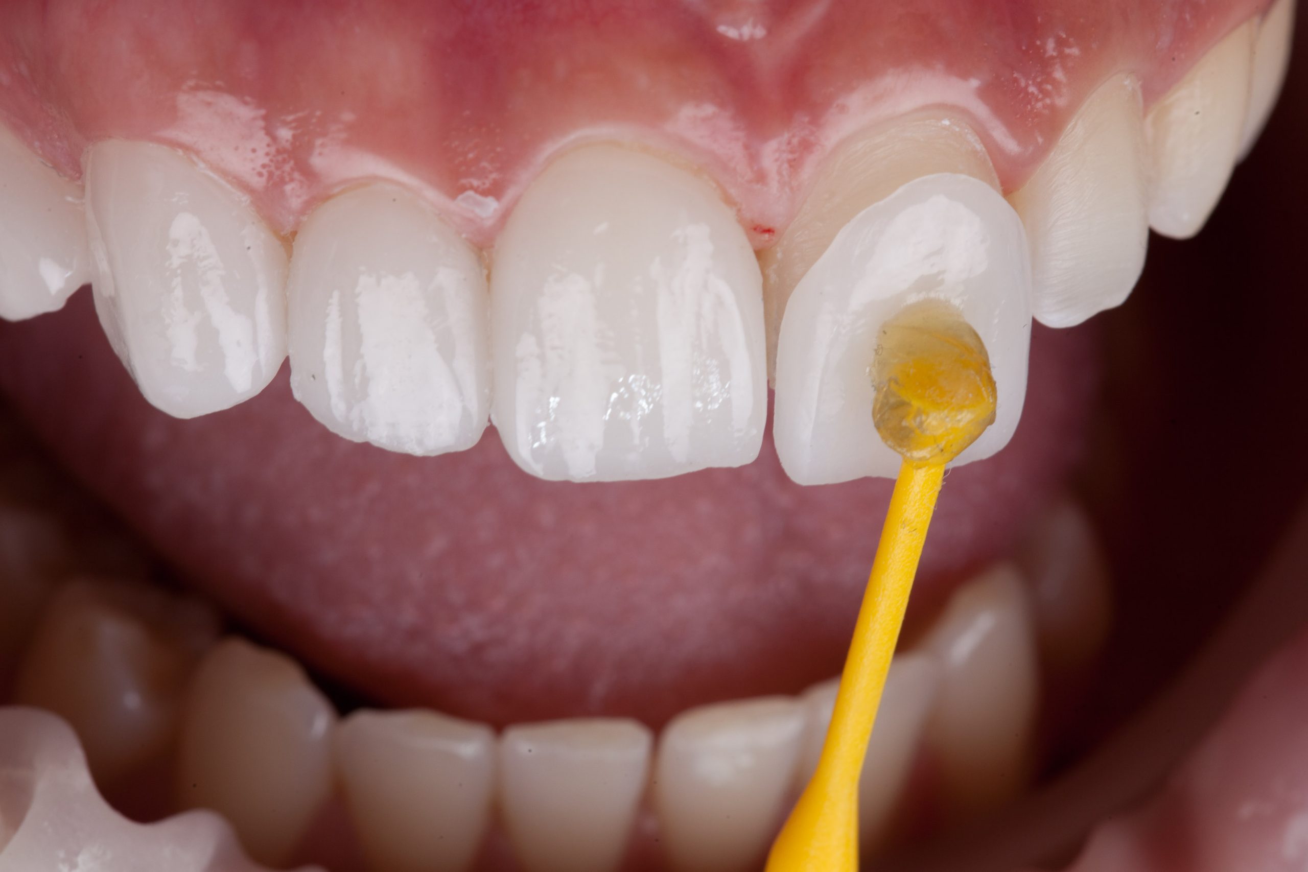 up close of veneer application process
