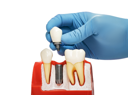 wakefield prosthodontist demonstrating placing dental implant