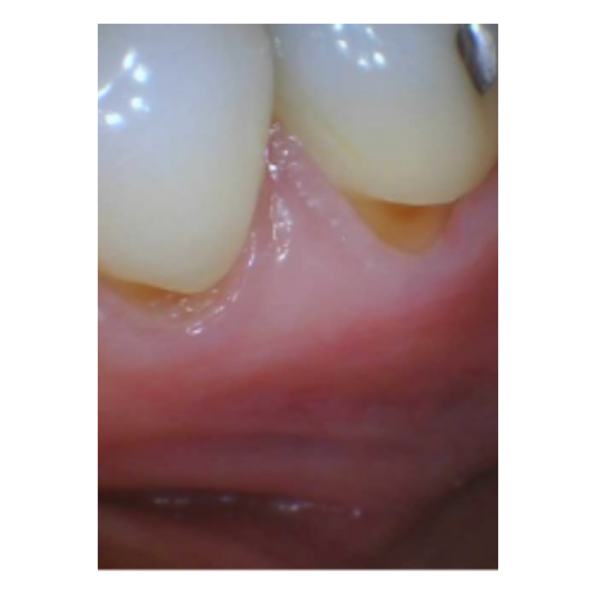 before gum disease treatment at Future of Dentistry