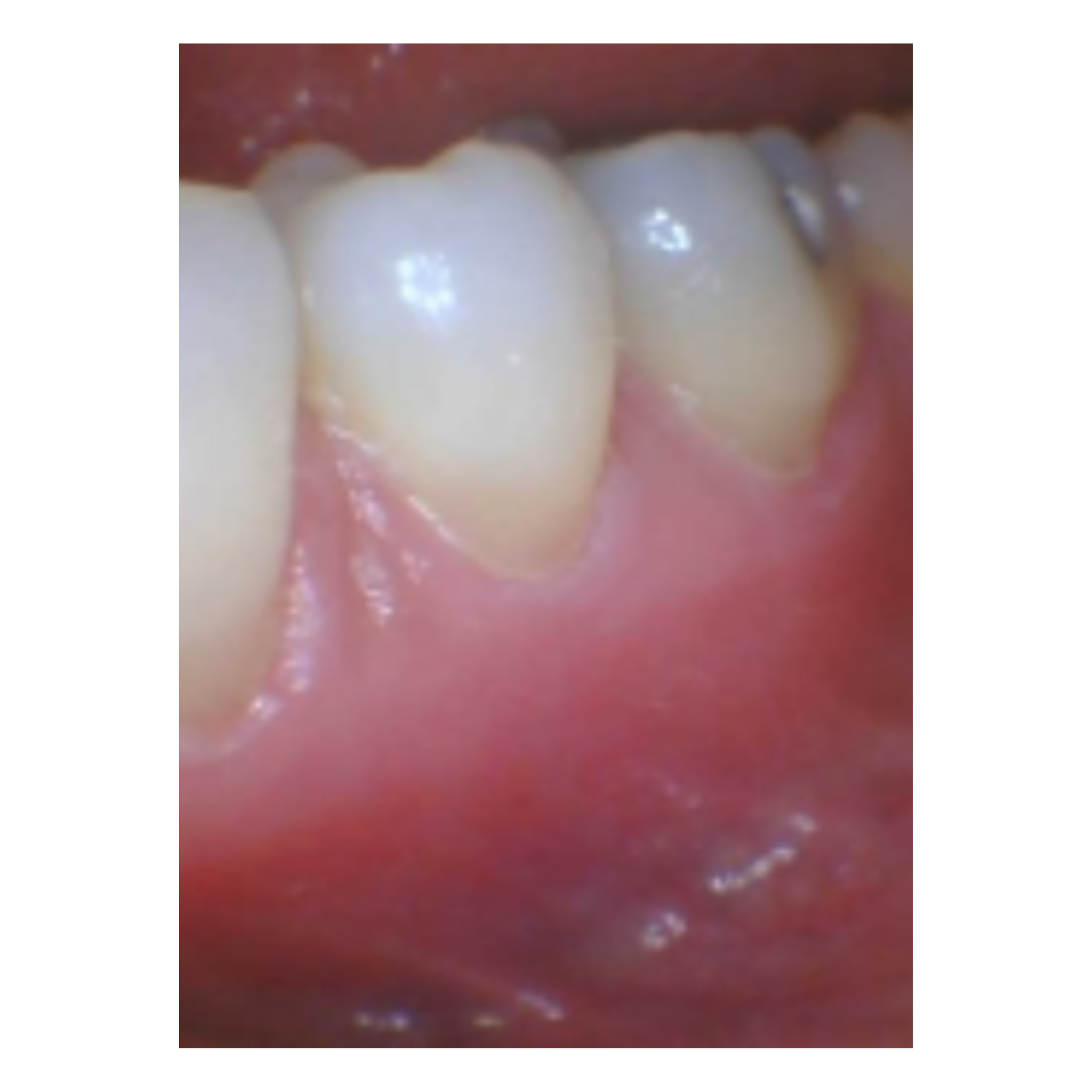 after gum disease treatment at Future of Dentistry