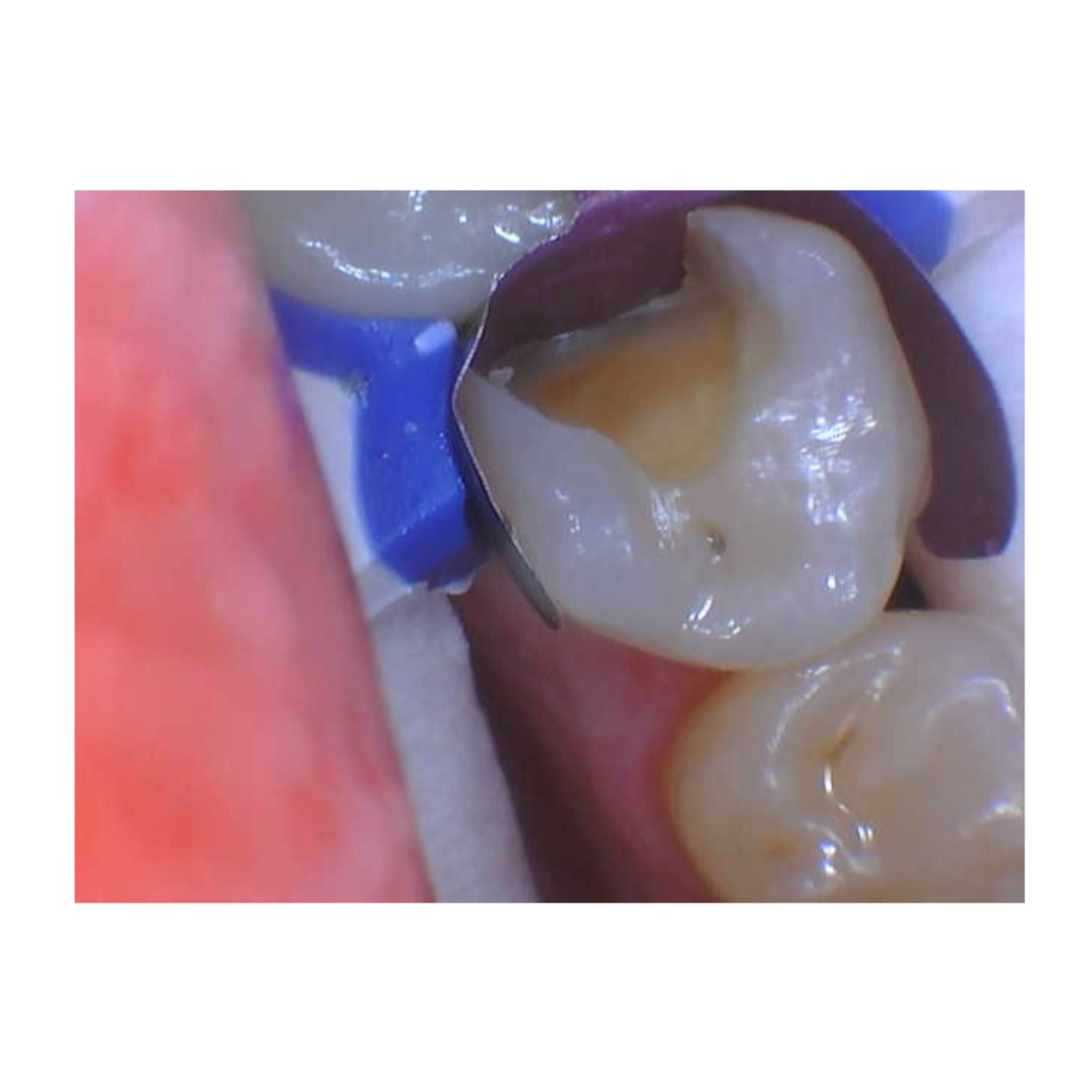 before tooth repair in North Andover