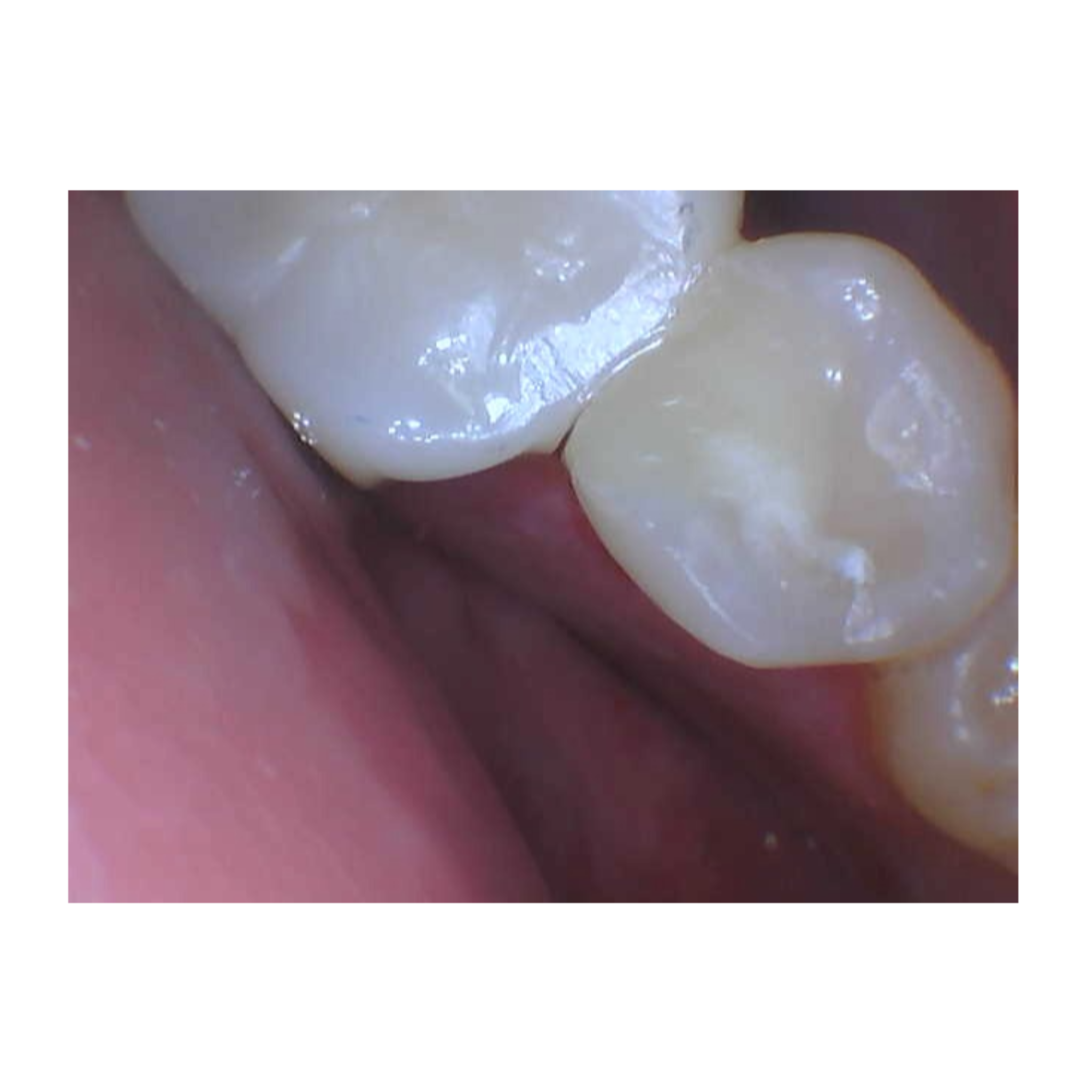 after tooth repair in North Andover