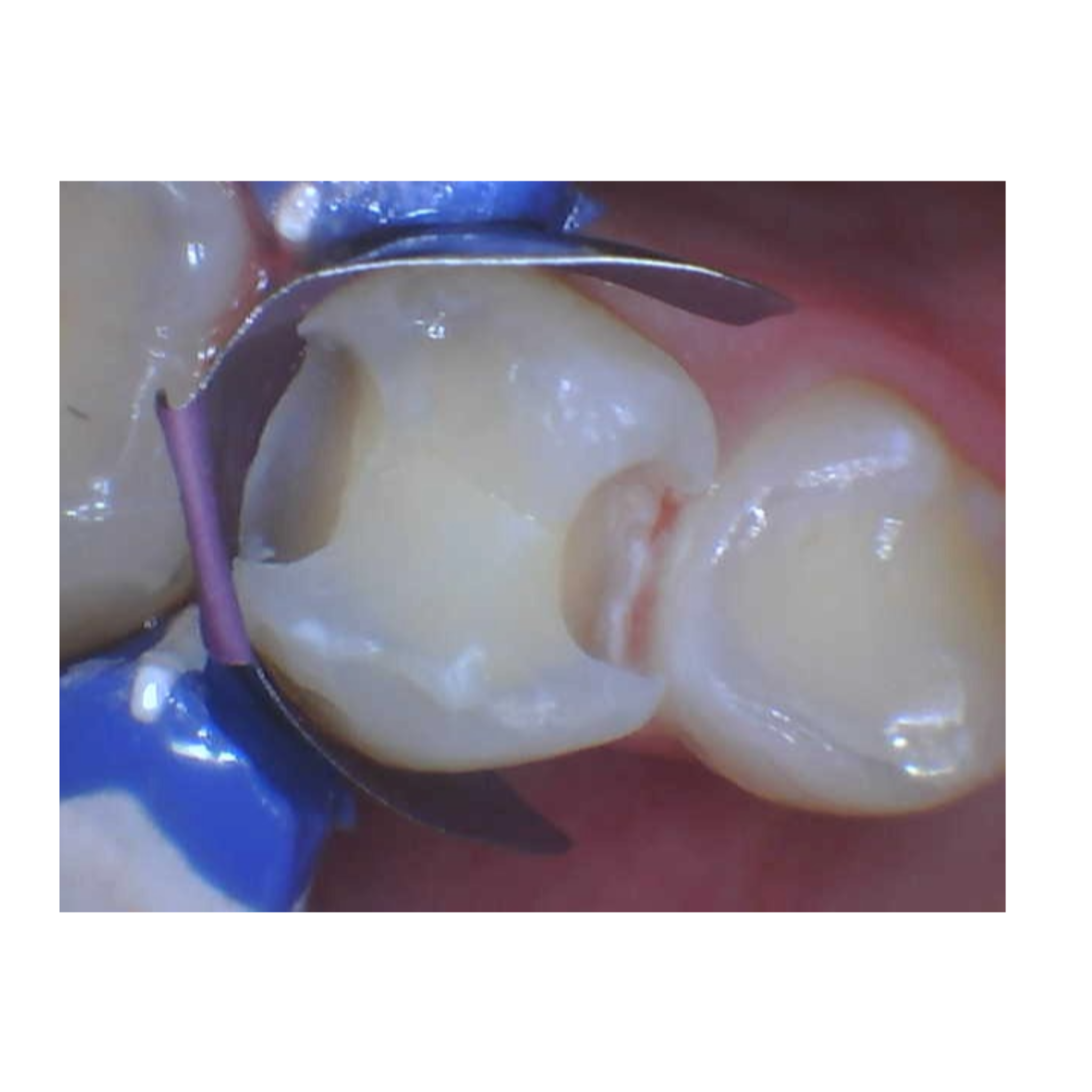 before tooth restoration at Future of Dentistry North Andover