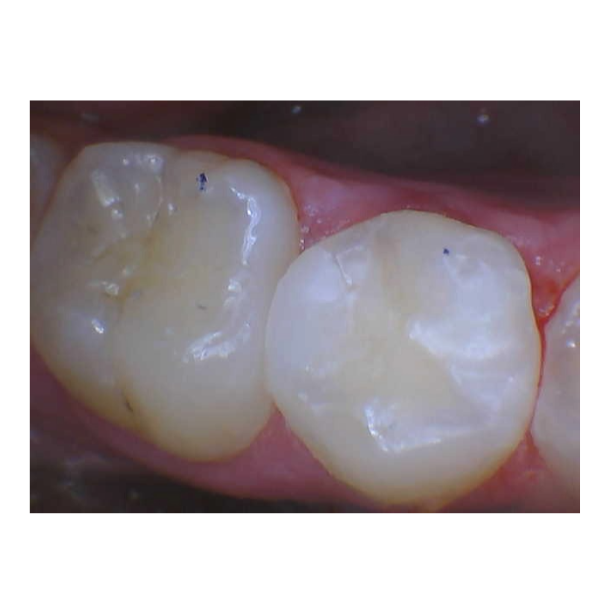 after tooth restoration at Future of Dentistry North