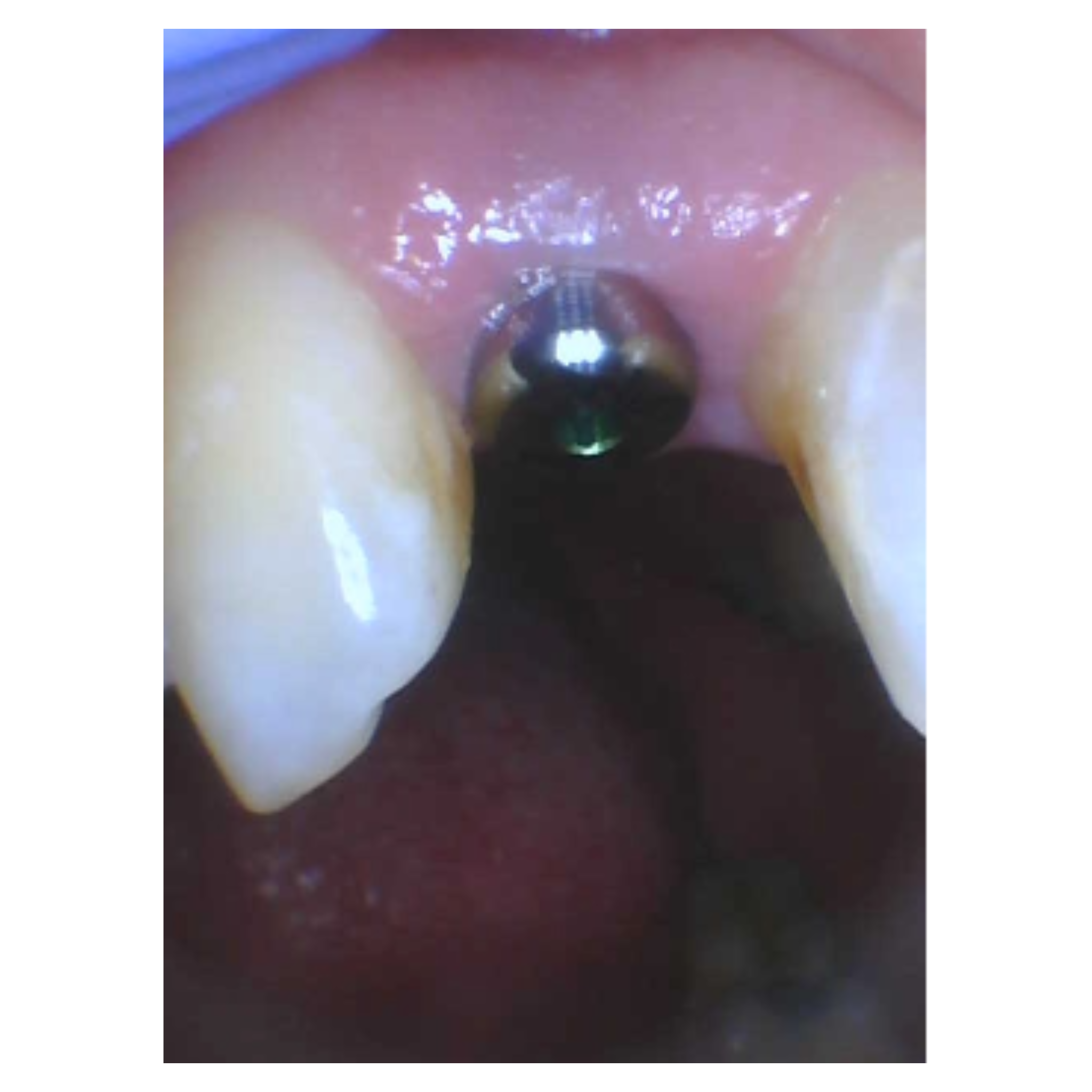 before dental implant at Future of Dentistry North Andover