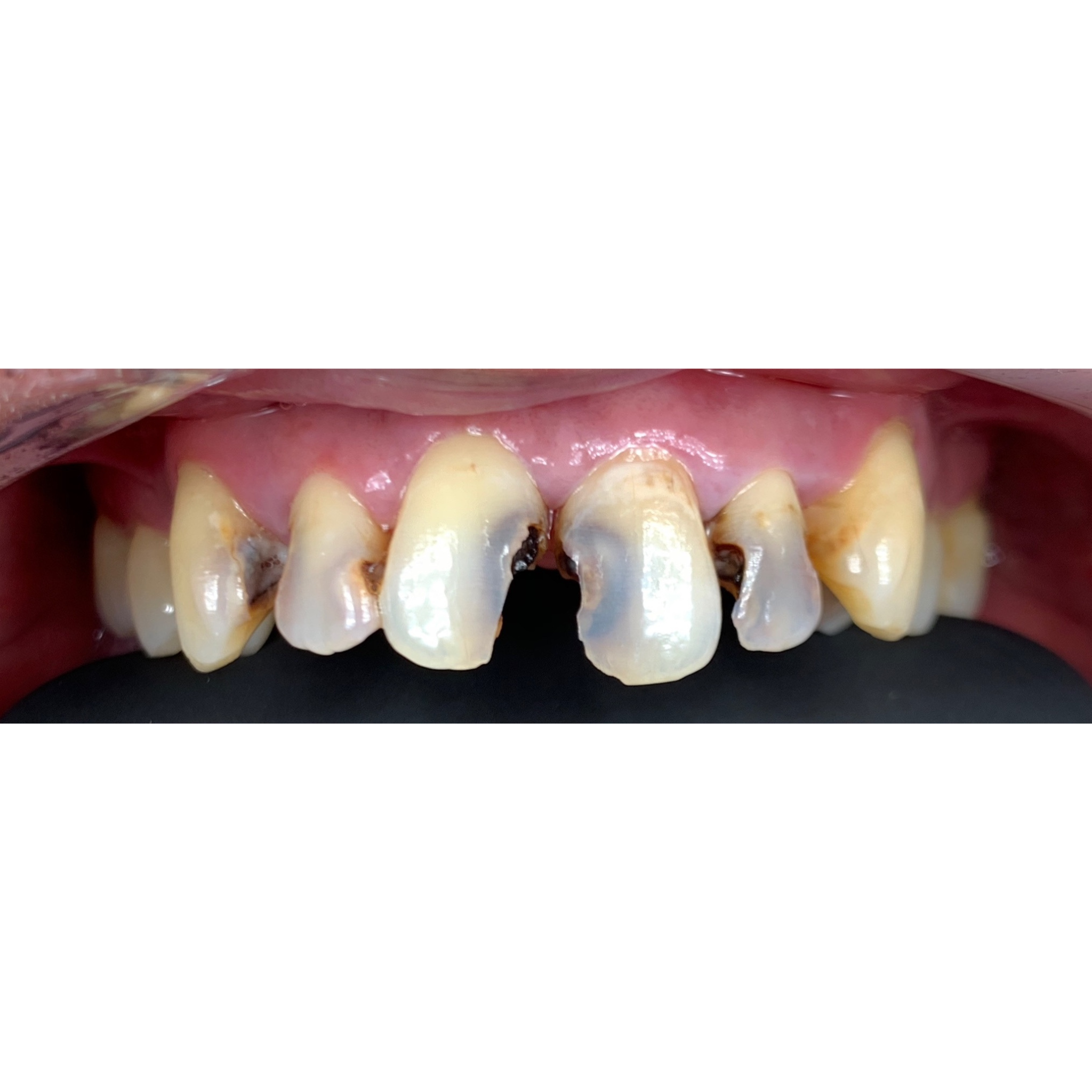 before smile makeover at Future of Dentistry