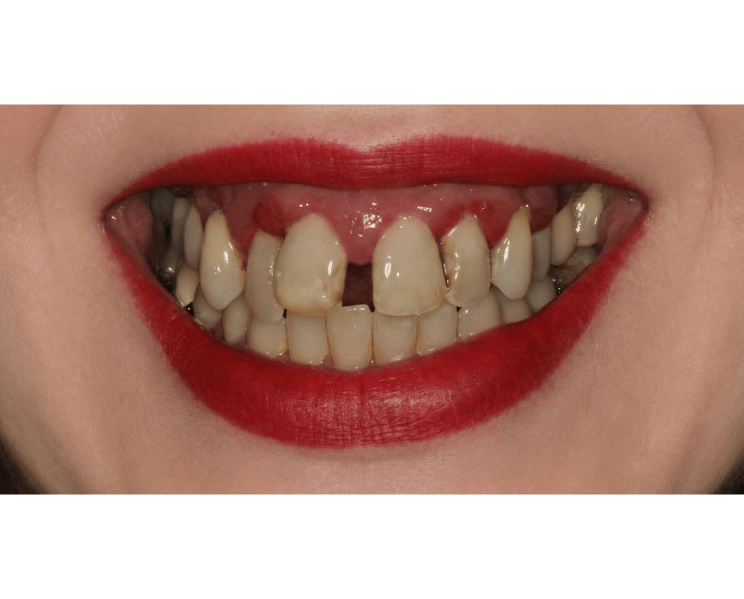 Before photo of patient with missing and worn teeth prior to full mouth reconstruction and prosthodontic dental implant treatment in Wakefield MA