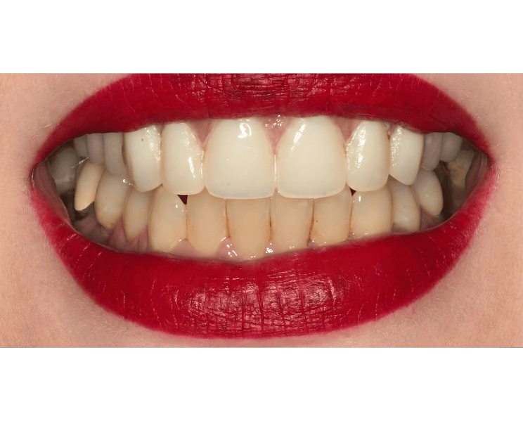 After photo of patient smile following full mouth reconstruction and prosthodontic dental treatment at Future of Dentistry in Wakefield MA