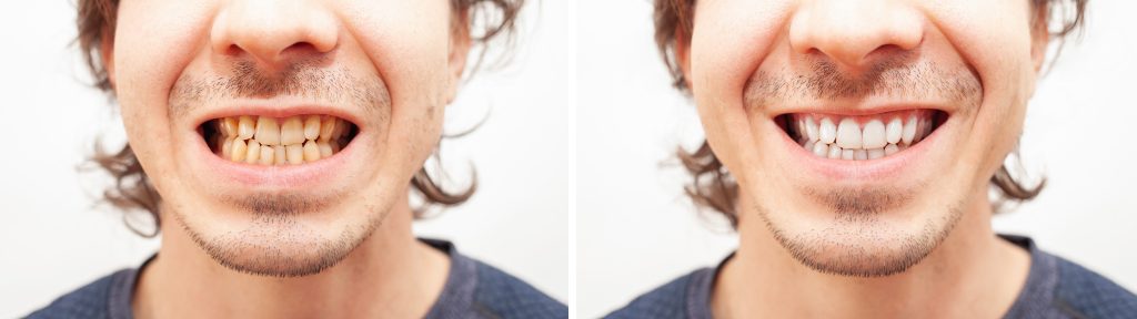 before and after of teeth whitening treatment
