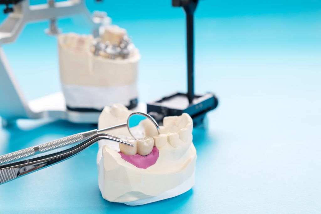 Implant Prosthodontics or Prosthetic / Tooth