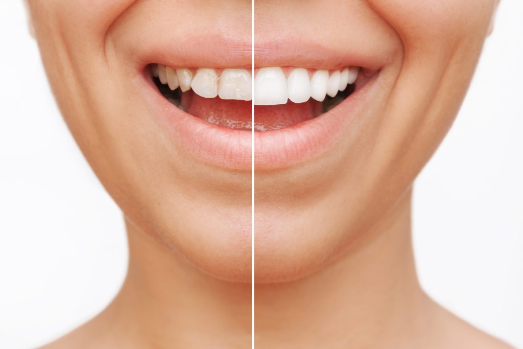 before and after of a woman's dental veneers